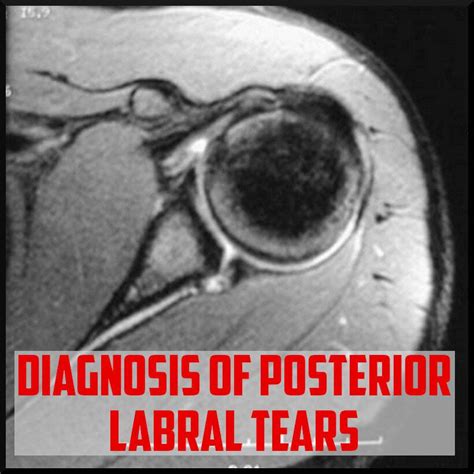 shoulder posterior labral tear test|how to tell if you tore your rotator cuff.